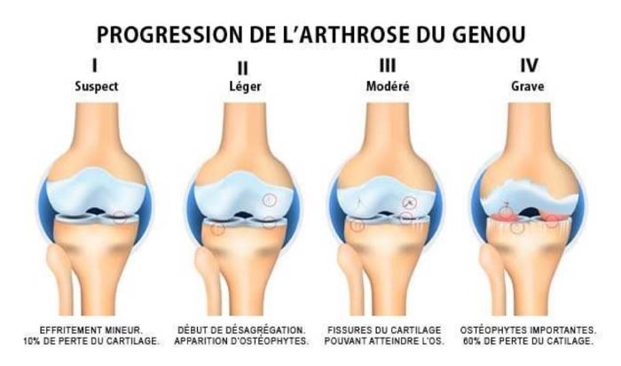 Embolisation de l'arthrose du genou